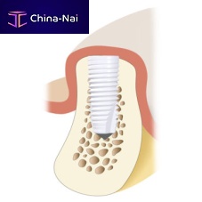 Cylindrical dental implant Z5-BLceramicinternalstraight