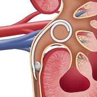 Ureteral stent JFil® nitinol