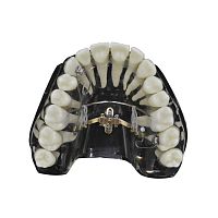 Tapered dental implant LIMtitaniumexternalstraight