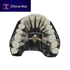 Tapered dental implant LIMtitaniumexternalstraight