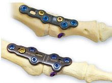 Foot phalange arthrodesis plate CheckMATE®non-lockingmetallic