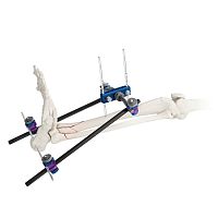 Ankle external fixation system ARBOR®tubularadult
