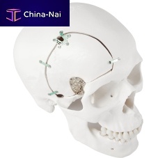 Non-absorbable cranial fixation system LeForte Neuro 0.3