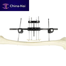 Femur external fixation system tubularadult