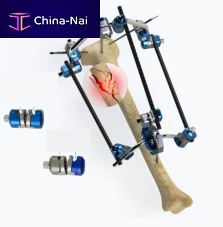 Tibia external fixation system circularadult