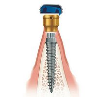 Titanium dental implant anatomicalnarroworthodontic anchor