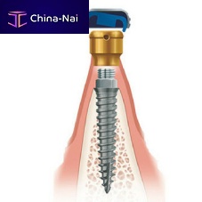 Titanium dental implant anatomicalnarroworthodontic anchor
