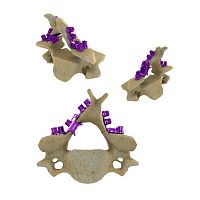 Cervical vertebra laminoplasty plate Blackbird HLSmetallic