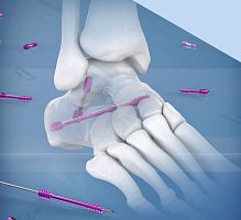 Carpal joint arthrodesis screw subtalar jointtalonavicular jointcannulated