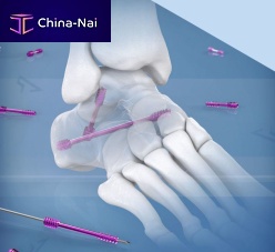 Carpal joint arthrodesis screw subtalar jointtalonavicular jointcannulated