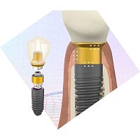 Cylindrical implant abutment BioBlock®titaniumexternalstraight
