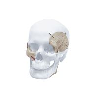 Custom-made cranial implant TRUMATCH
