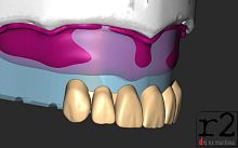 Dental software BiteReg designmodelingimport