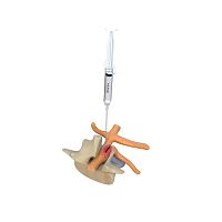 Gel adhesion barrier BETAMIXabdominal laparotomypelvic laparotomycesarean surgery