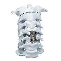 Cervical arthrodesis plate CAP 1 level