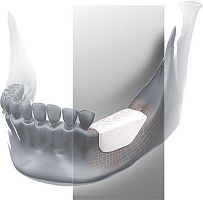 Allograft bone substitute for dental sugeryrigid