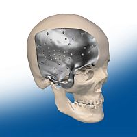 Custom-made cranial implant