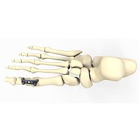 Hallux valgus arthrodesis plate FRC20 serieslockingmetallic