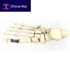 Hallux valgus arthrodesis plate FRC20 serieslockingmetallic