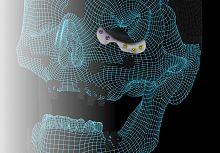 Custom-made periorbital implant ORBIT