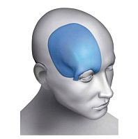 Custom-made cranial implant Matrix Omnipore®