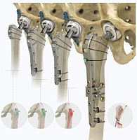 Femur compression plate