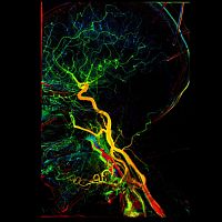 Hospital software KMITangiographyfor neuroimagingvascular surgery