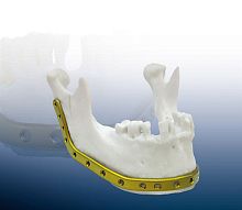 Mandible compression plate REAL FITlockingtitanium