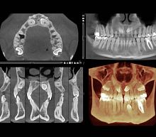 Medical software Romexis®dentalmedical imagingmaxillofacial surgery