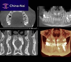 Medical software Romexis®dentalmedical imagingmaxillofacial surgery