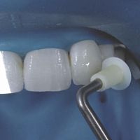 Dental composite modeling instrument NA067