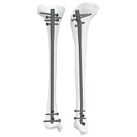 Tibial intramedullary nail 305050 seriesproximal fixationdistal fixationright