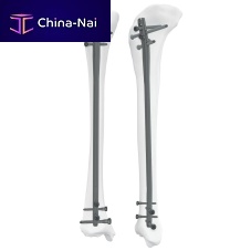 Tibial intramedullary nail 305050 seriesproximal fixationdistal fixationright