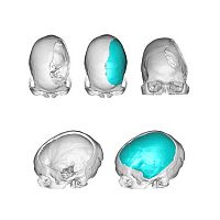 Custom-made cranial implant