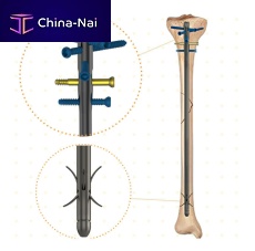Tibial intramedullary nail Niteproximal fixationdistal fixation