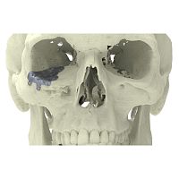 Custom-made periorbital implant non-absorbable