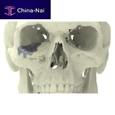 Custom-made periorbital implant non-absorbable