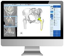 Hospital software ZedViewCTfor hip surgeryanalysis