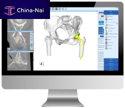 Hospital software ZedViewCTfor hip surgeryanalysis