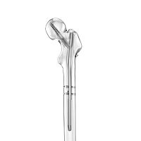Proximal fixation intramedullary nail 7500 seriestitanium