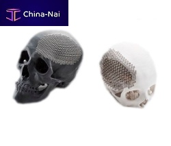 Custom-made cranial implant JCI