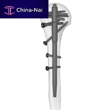 Humeral intramedullary nail 305077 seriesproximal fixationdistal fixationright