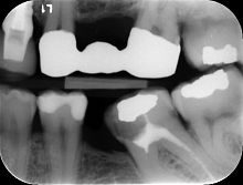Caries detection software clinicalimage analysisdiagnostic