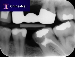 Caries detection software clinicalimage analysisdiagnostic