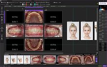 Image editing software Photoalignmedicalfor dental imagingplastic surgery