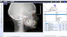 Orthodontic software OrthoTPanalysis