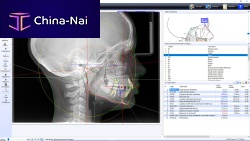 Orthodontic software OrthoTPanalysis
