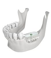 Titanium dental material CTi-memfor dental restorations