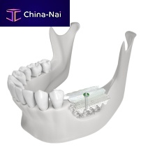 Titanium dental material CTi-memfor dental restorations