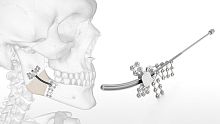 Mandibular distractor Logic internaladult